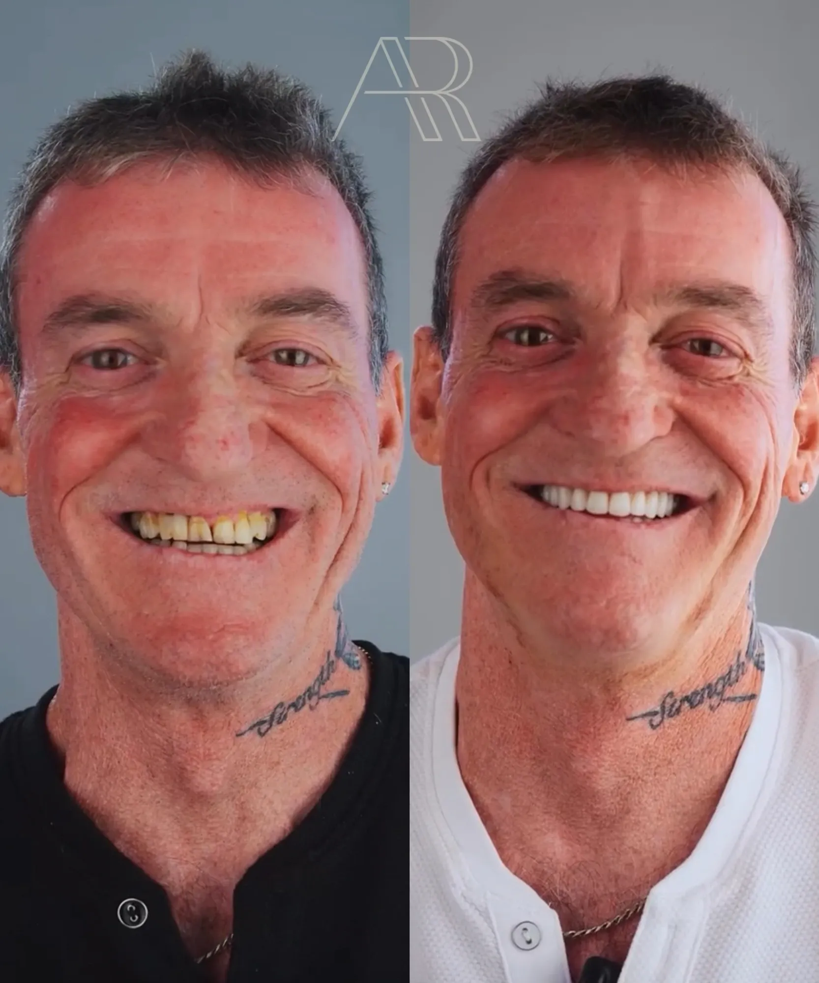 Antes e depois de protocolo sobre implantes: segundo paciente de frente, sorrindo