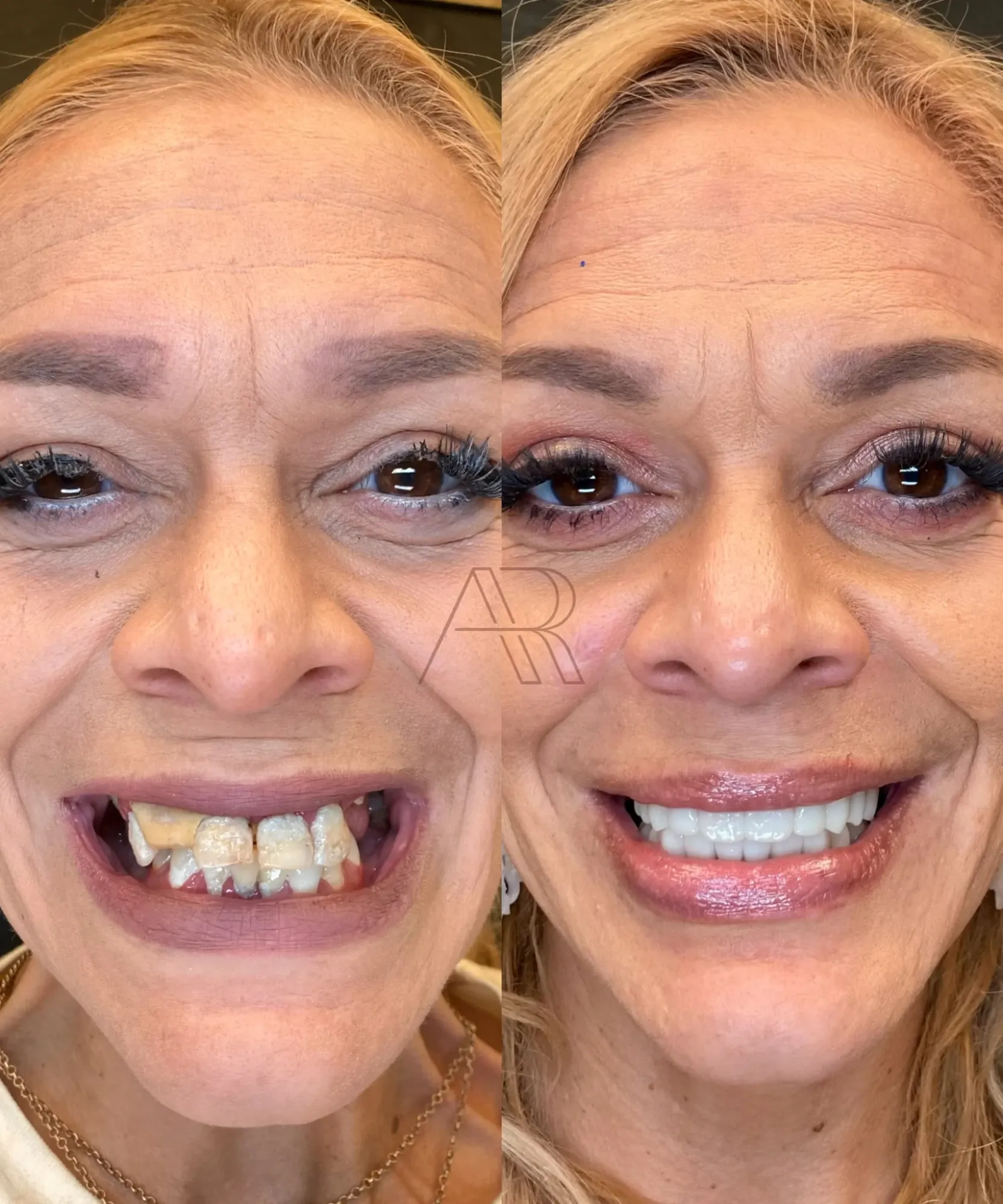 Antes e depois de protocolo sobre implantes: terceira paciente de frente, sorrindo
