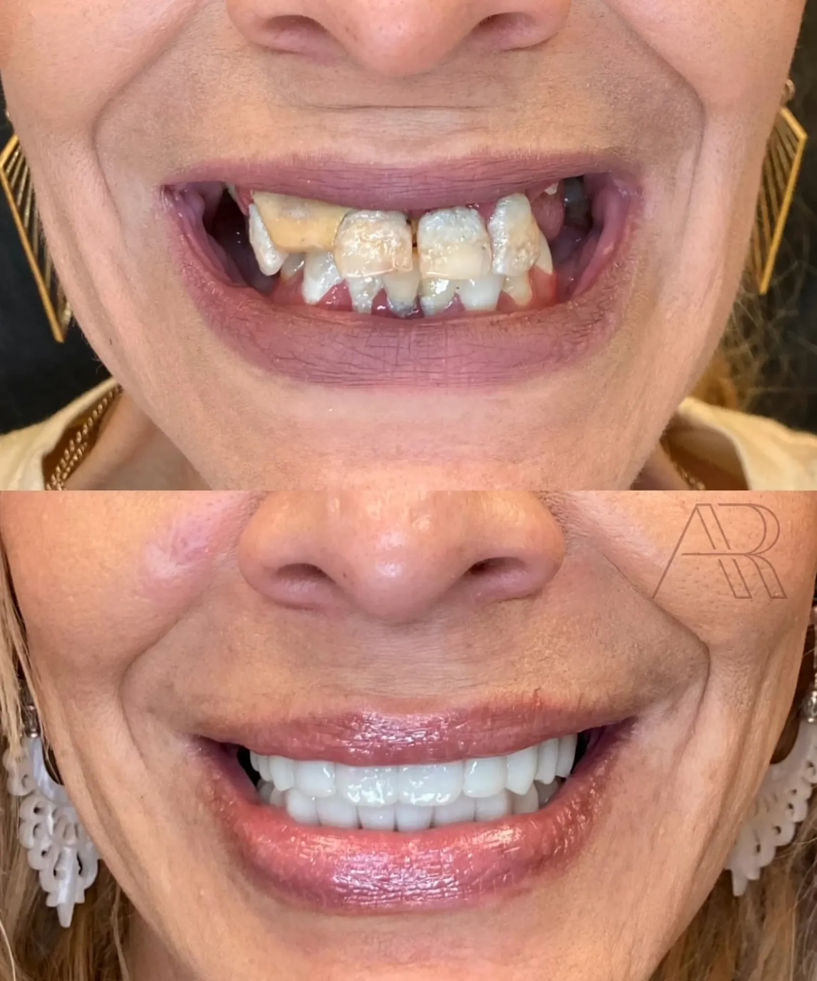 Antes e depois de protocolo sobre implantes: detalhe do sorriso da terceira paciente